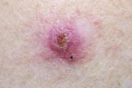 Basal Cell Carcinoma Treatments On The Horizon Dermatology Times Case Basal Cell Carcinoma Treatments On The Horizon Dermatology Times Case
