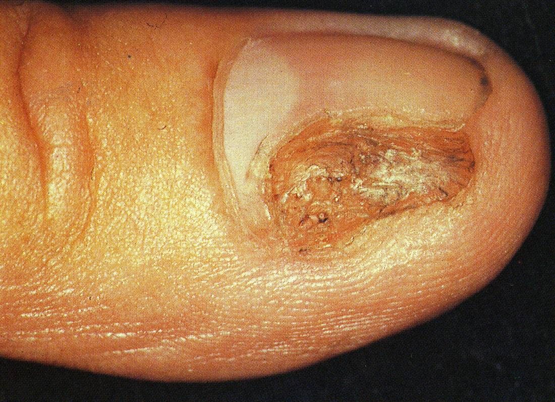 neoplasms