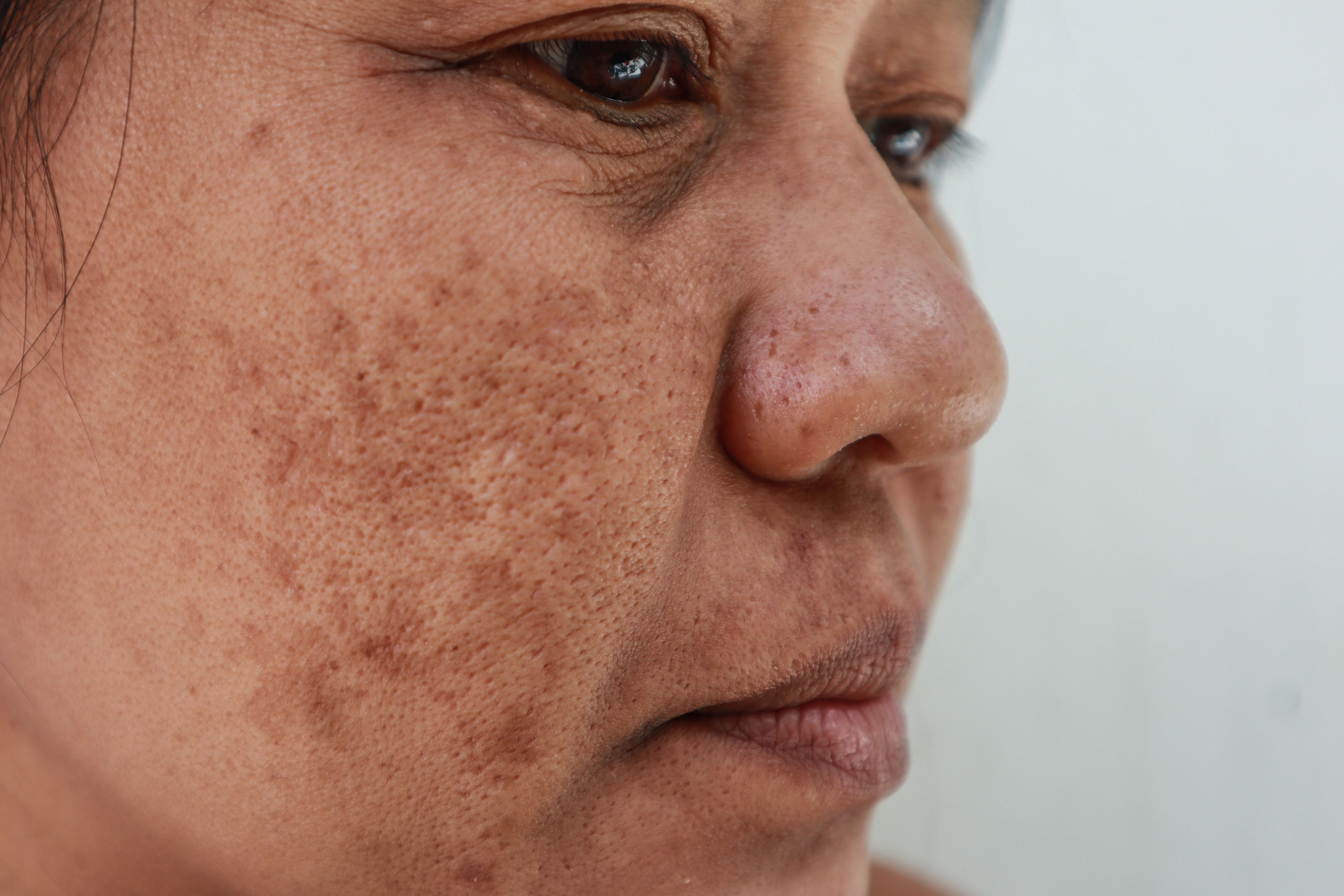 How Medium-to-Deep Chemical Peels Tackle Refractory Melasma