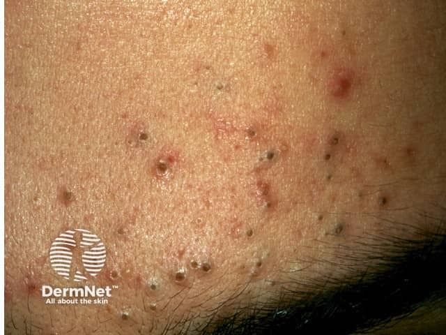 Study Finds Resilience Boosts Life Quality in Acne