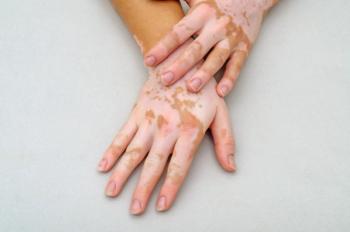 Vitiligo