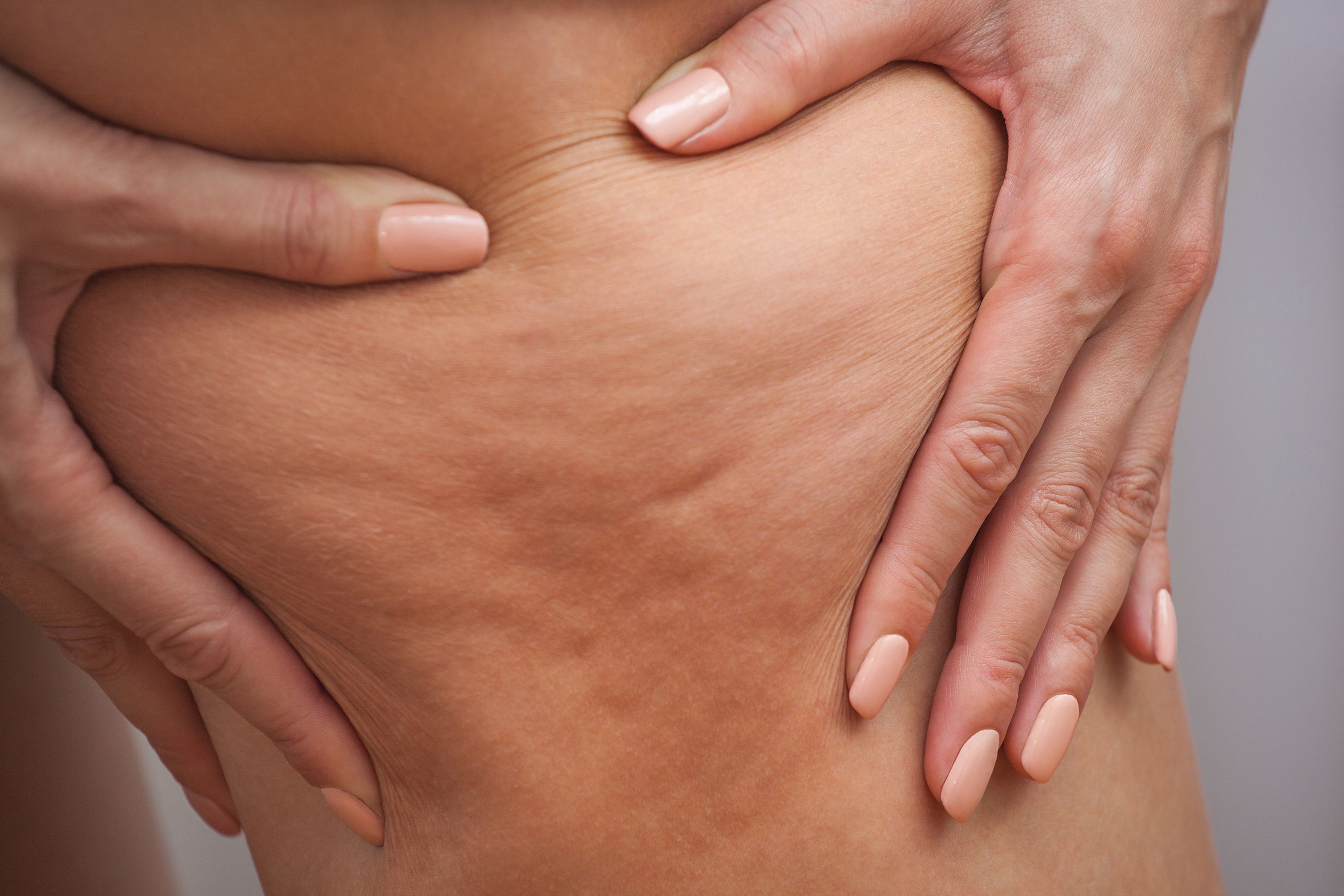 Triple-Frequency Ultrasound Proven to Be Effective in Reducing Cellulite 