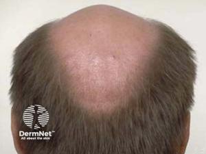 Androgenetic alopecia