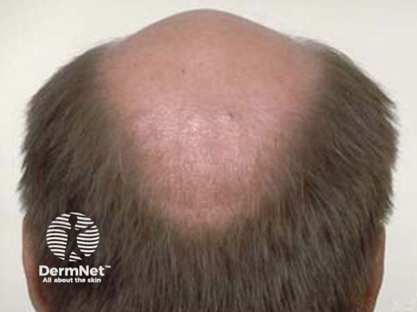 Androgenetic alopecia