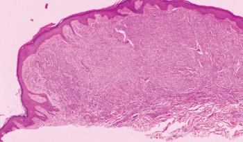 melanoma lesion