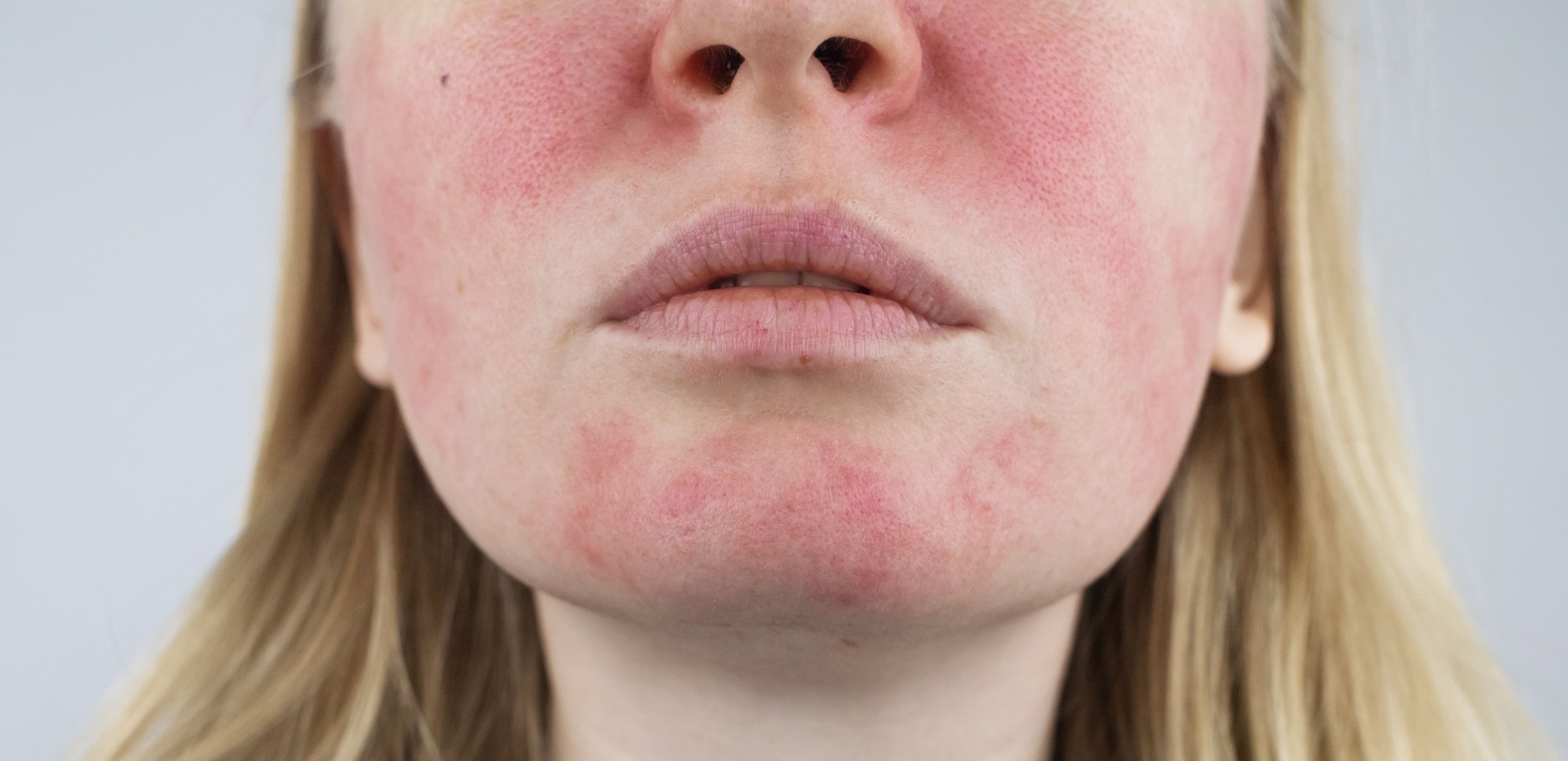 Oxymetazoline Efficacious in Reducing Rosacea-Associated Facial Erythema