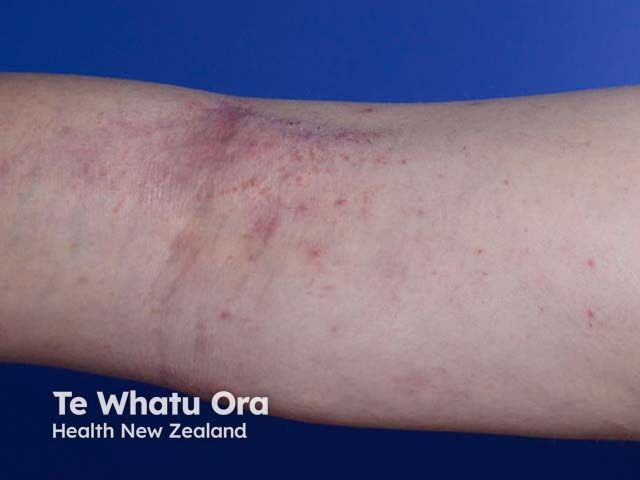 LEO Pharma Presents Late-Breaking Results on Temtokibart for Atopic Dermatitis at EADV