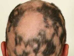 Poster Presentations Demonstrate Efficacy of Deuruxolitinib in Patients With Moderate to Severe Alopecia Areata