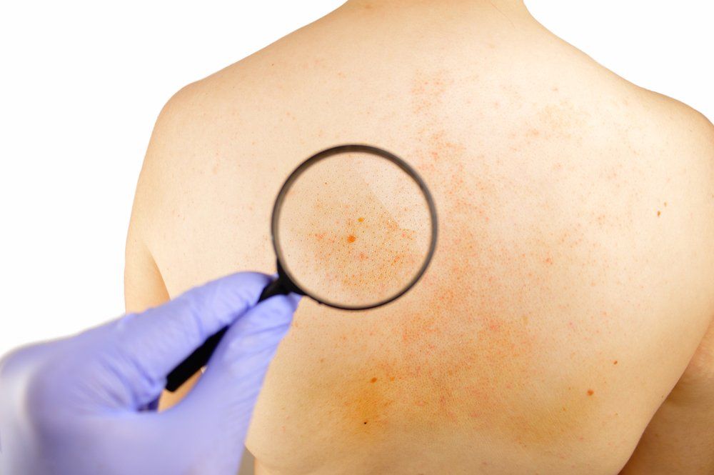 Skin Cancer Basal Cell Carcinoma MedlinePlus