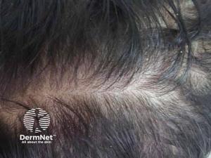 Interim Trial Results and Preclinical Data Highlight Potential of ABS-201 in Androgenetic Alopecia