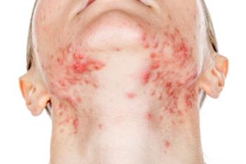 woman acne