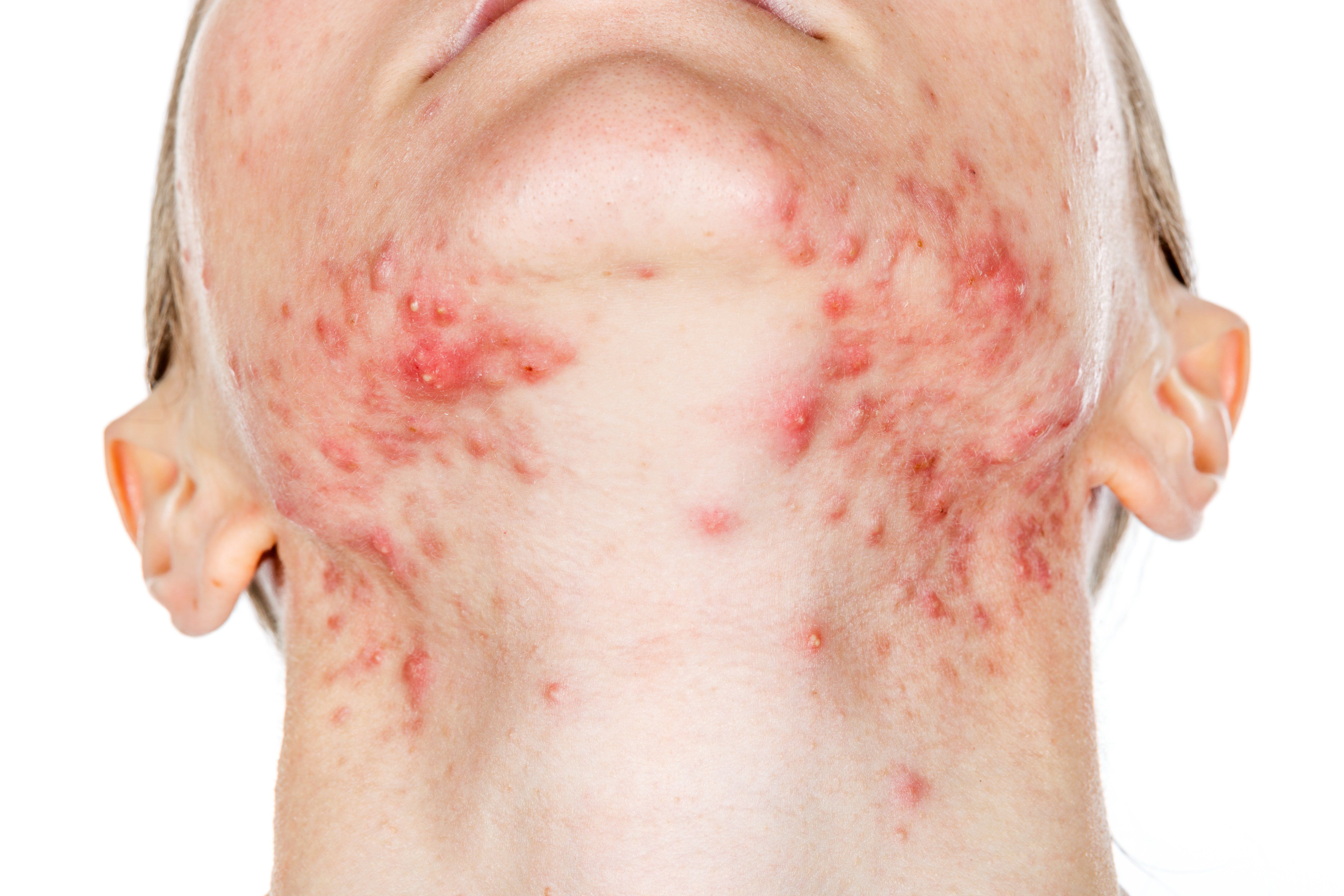 Acne Infectado FDA approves tretinoin lotion acne treatment