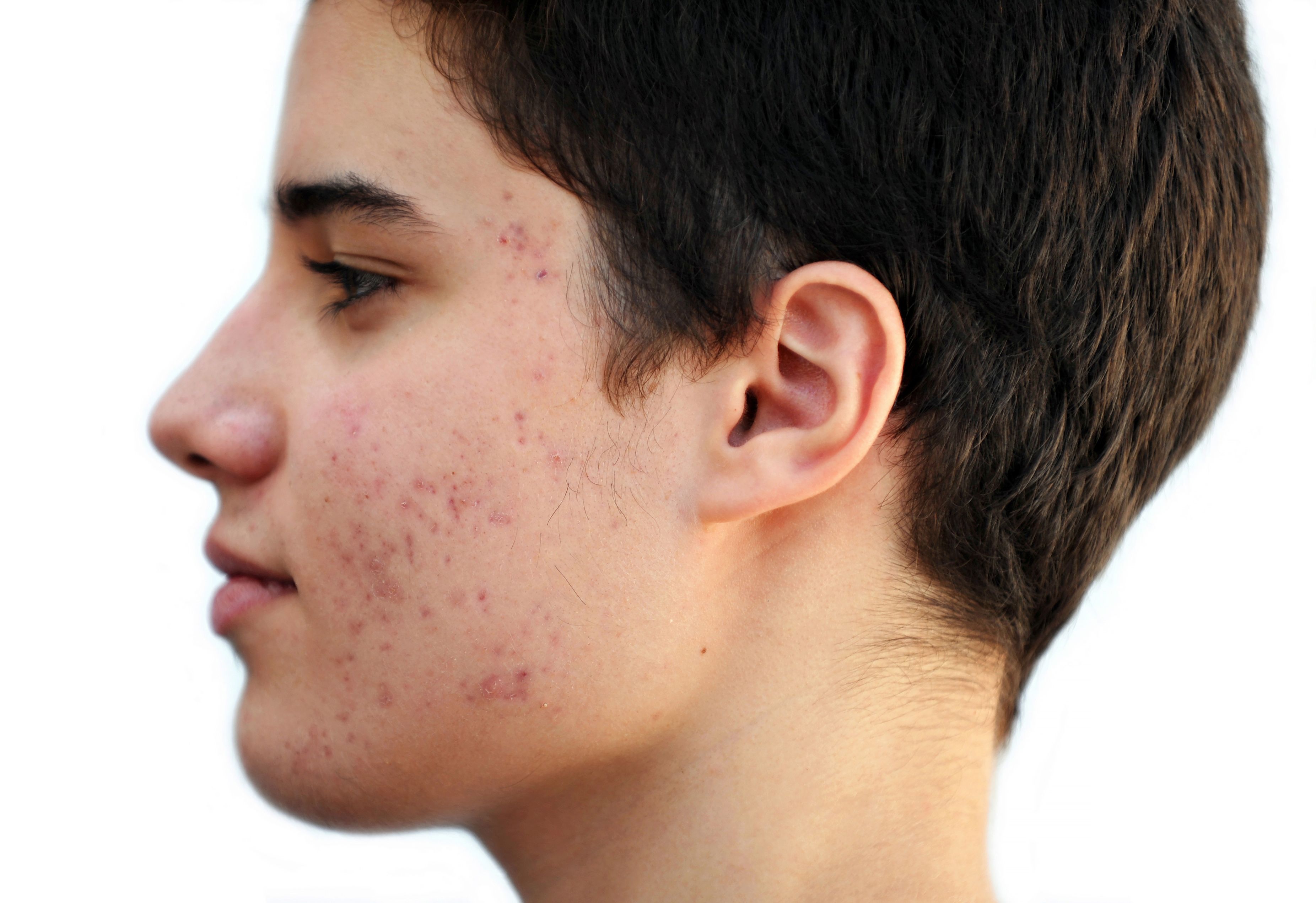 Acne. Акне вульгарис у подростков.