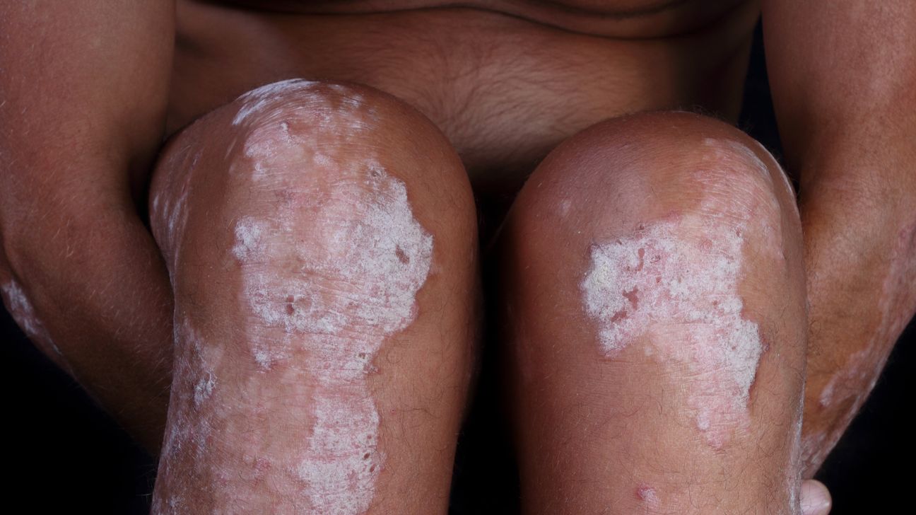 Psoriasis in skin of color patient