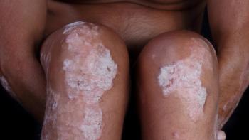 Psoriasis in skin of color patient