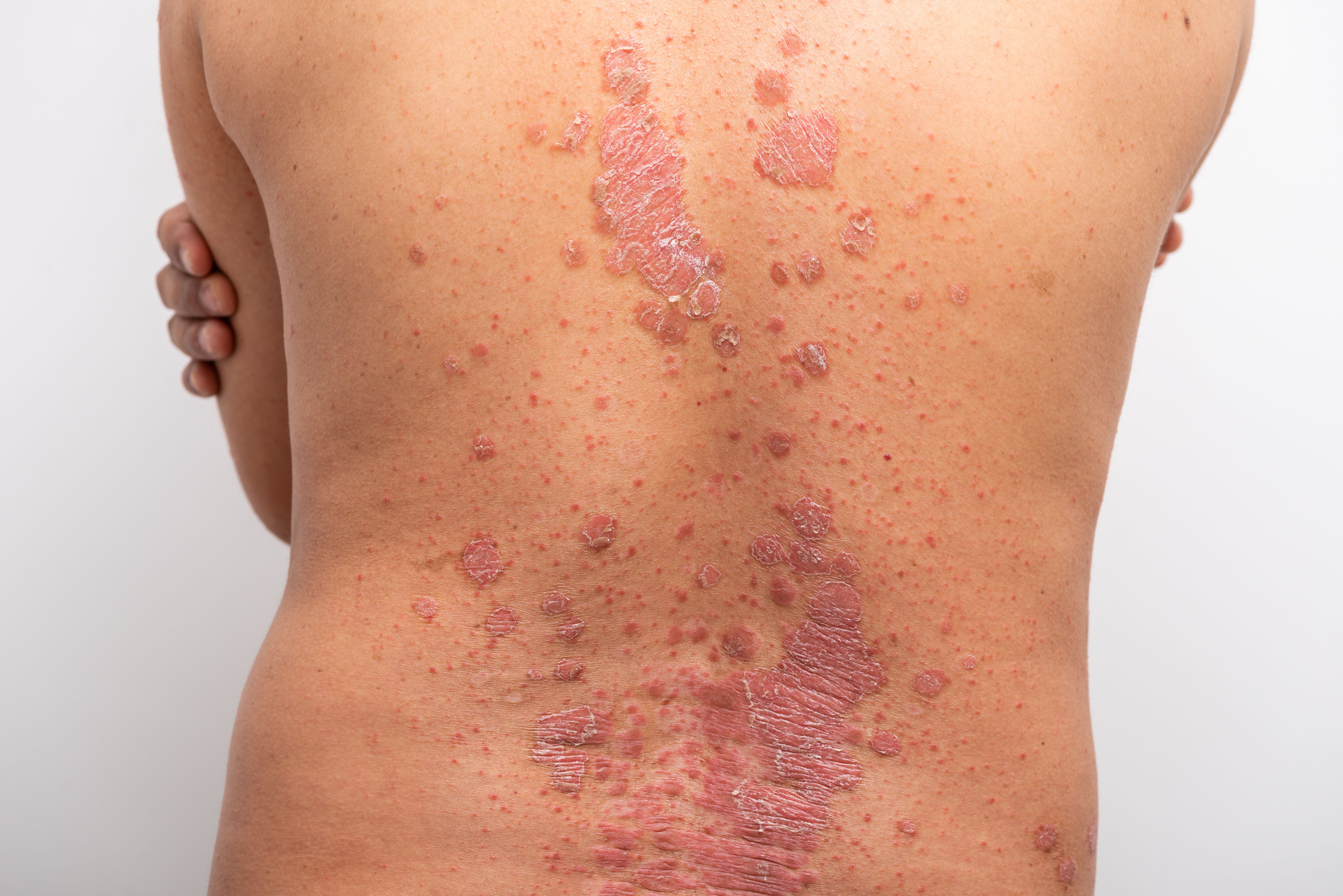 Novel PDE4 Inhibitor ME3183 Shows Efficacy for Plaque Psoriasis in Phase 2 Trial