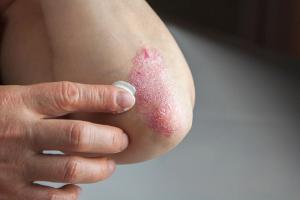 Plaque Psoriasis Treatment Gets Even More Company