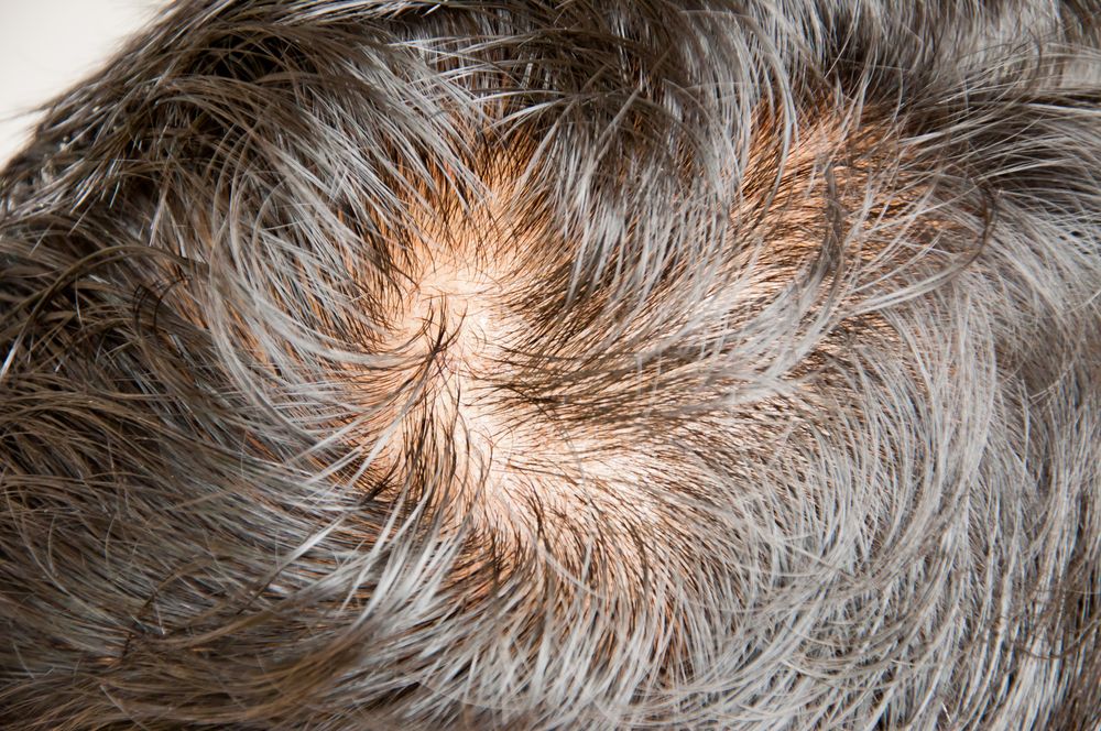 Dermatologist explains over-the-counter hair loss treatments