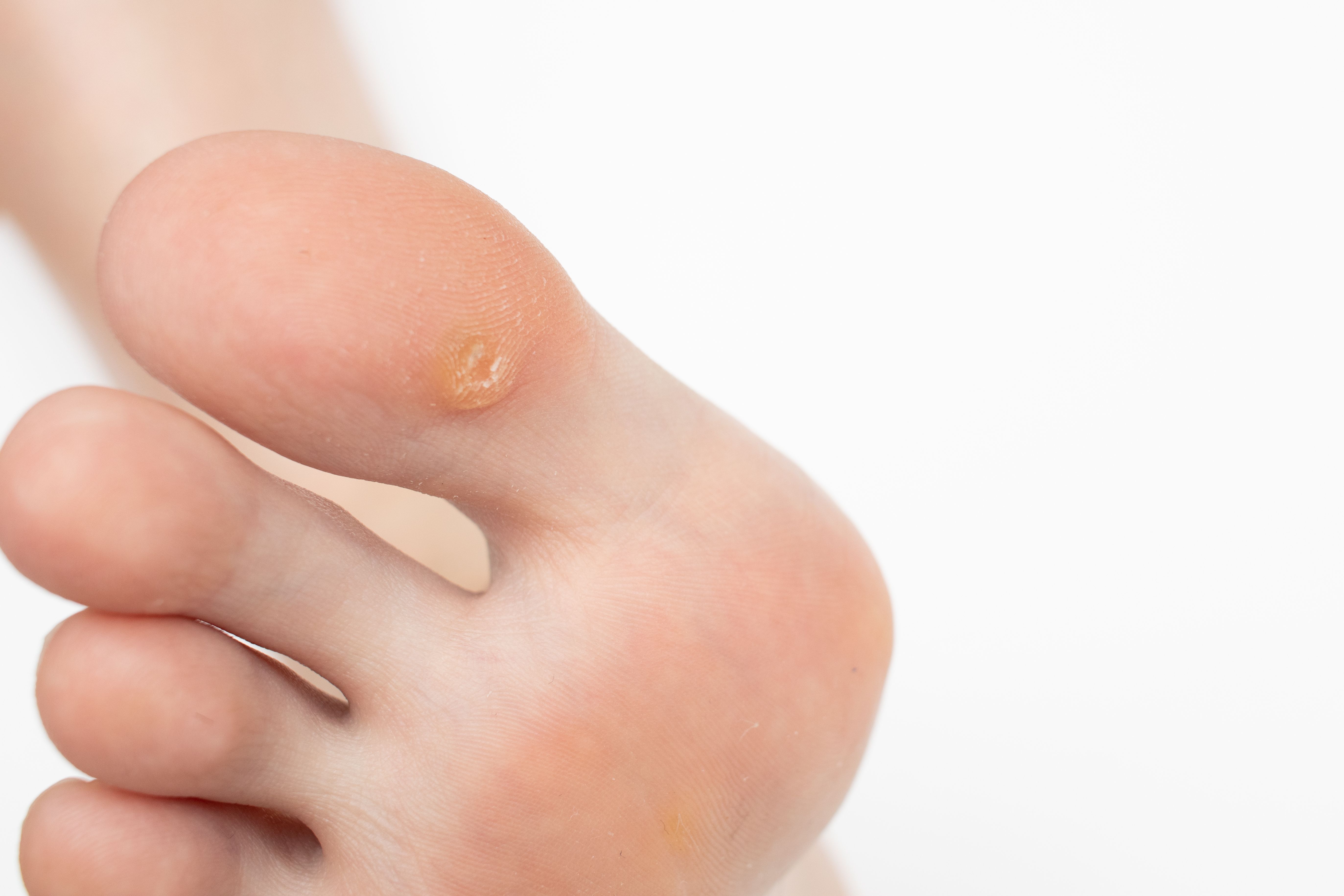 Microwave Therapy Successful For Treating Warts In Children microwave-therapy-successful-for-treating-warts-in-children