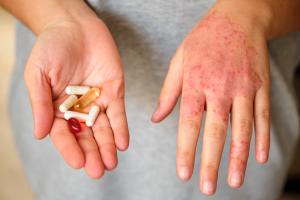 The Emerging Role of Oral Peptide Therapeutics in Dermatology