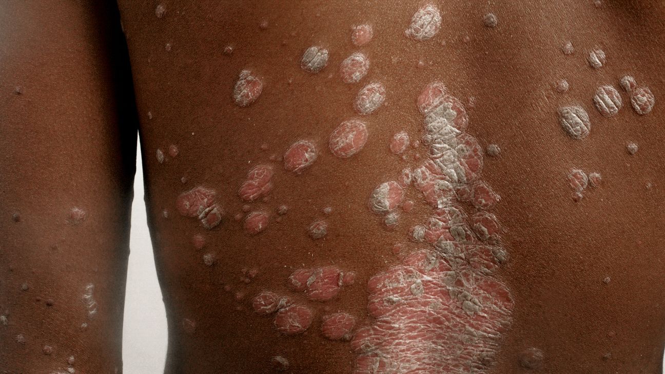 Psoriasis Strategies In Skin Of Color 