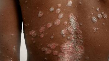 Psoriasis
