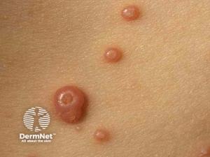 Beyond the Rash: What Dermatologists Need to Know About the World of Infectious Diseases