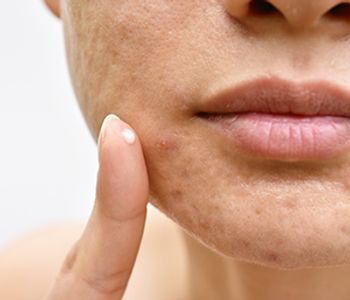 topical acne