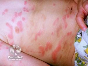 A Personal Journey With Chronic Spontaneous Urticaria