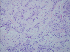 An Overview of Granulomatous Dermatitis   