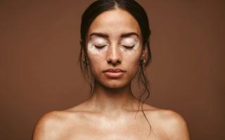 What's Happening in the Vitiligo Pipeline?