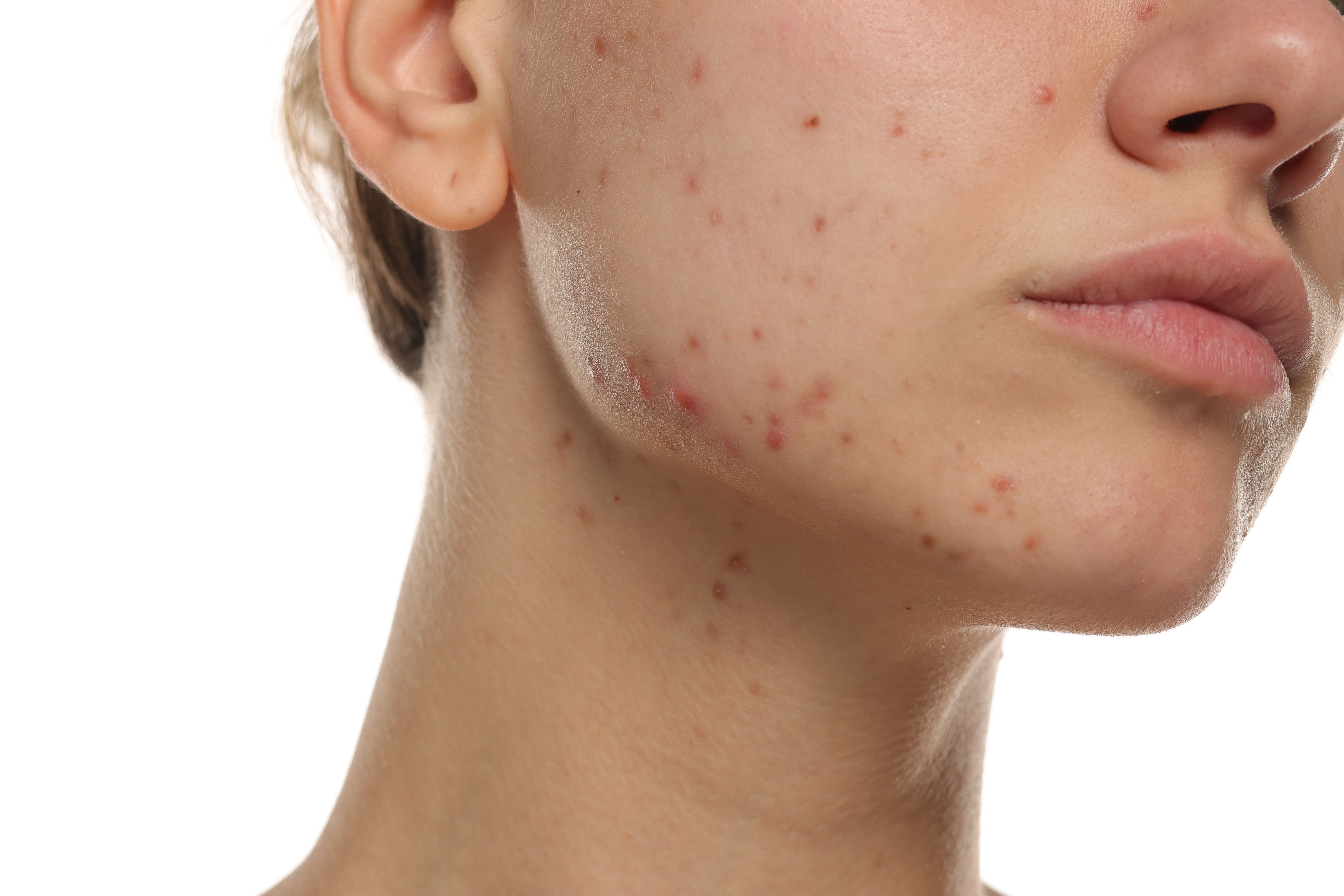 Ascletis Presents Positive Phase 3 Data for Denifanstat in Moderate-to-Severe Acne