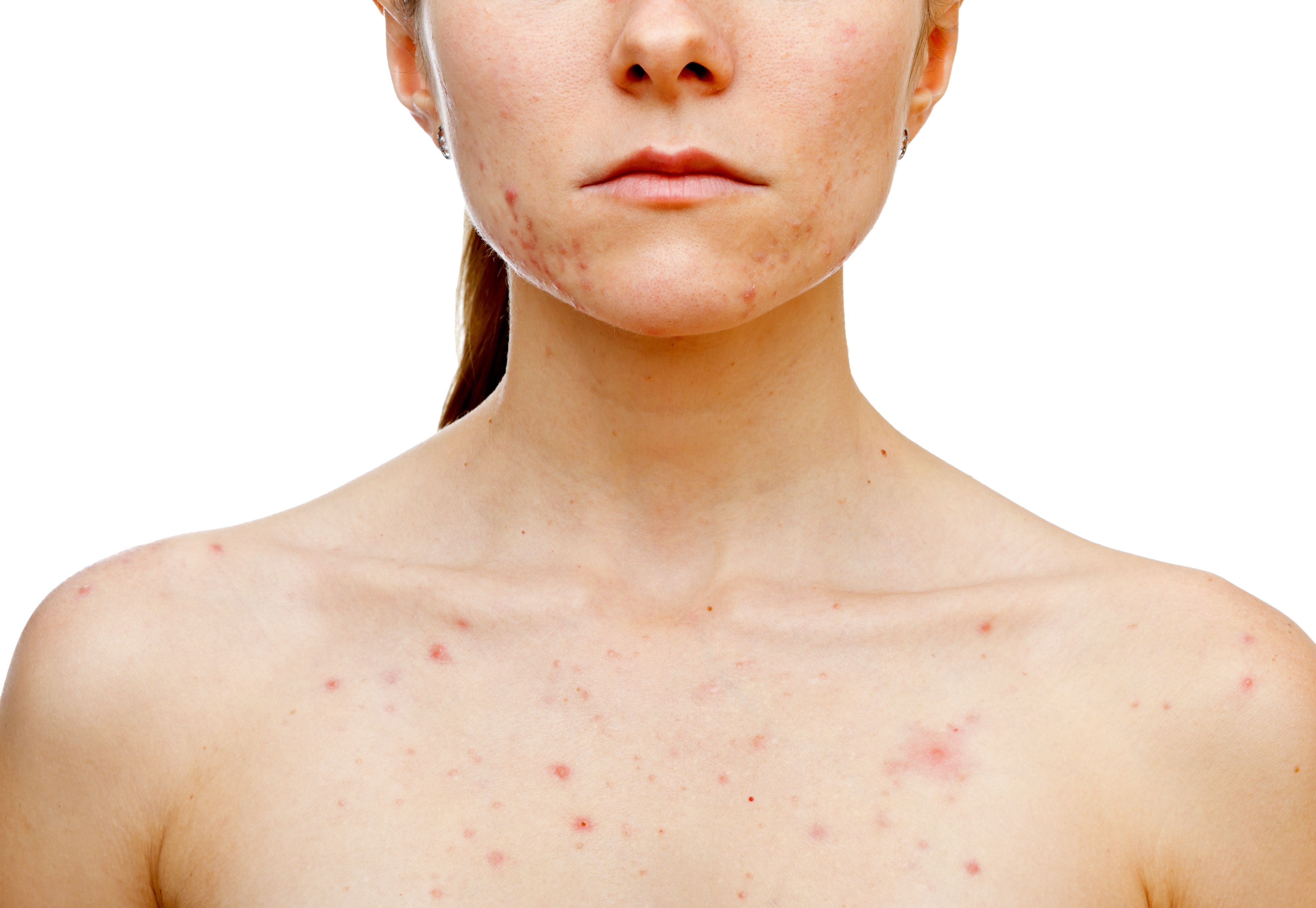 woman with acne