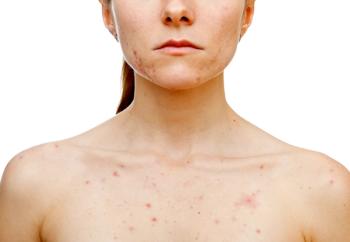 woman with acne