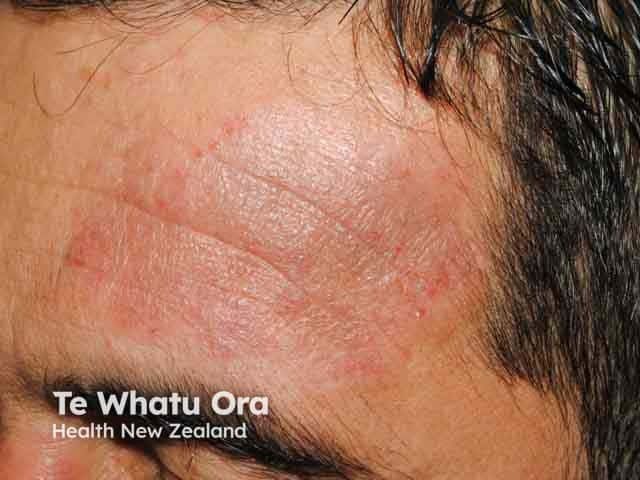 New Data Support Delgocitinib for Sensitive Skin Areas