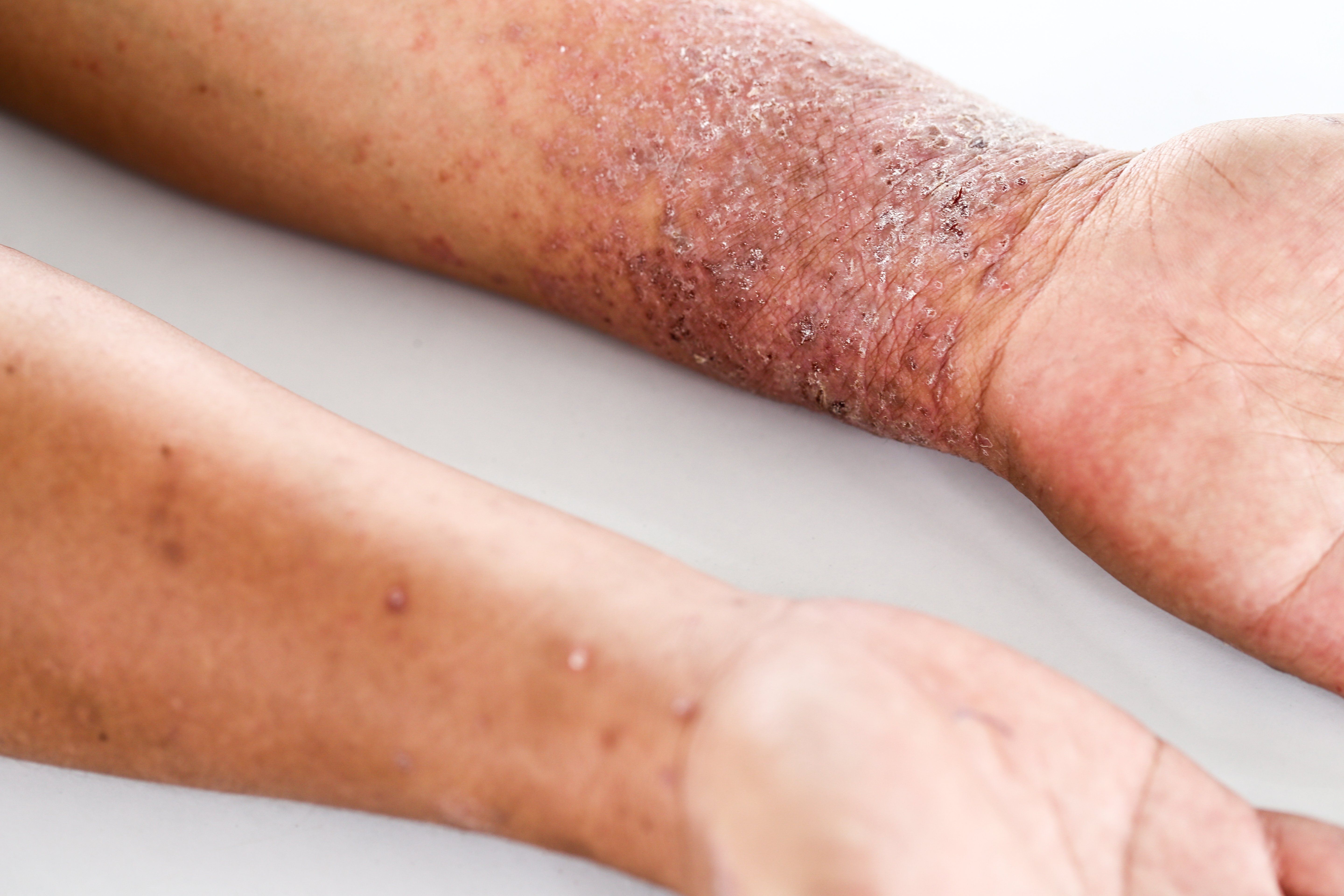 atopic dermatitis on arms
