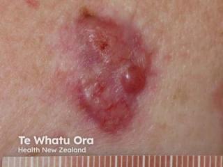 The Future of laBCC Treatment with Vishal Patel, MD, FAAD, FACMS