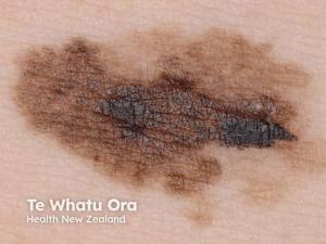 Personalized mRNA-Based Melanoma Vaccine Meets Primary Endpoints in Landmark Phase 3 Trial