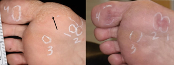 Warts treated with Nano-Pulse Stimulation