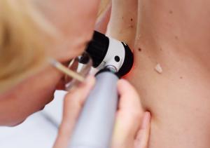 Topical Immunotherapy Combo Aims to Prevent Skin Cancer in High-Risk Patients