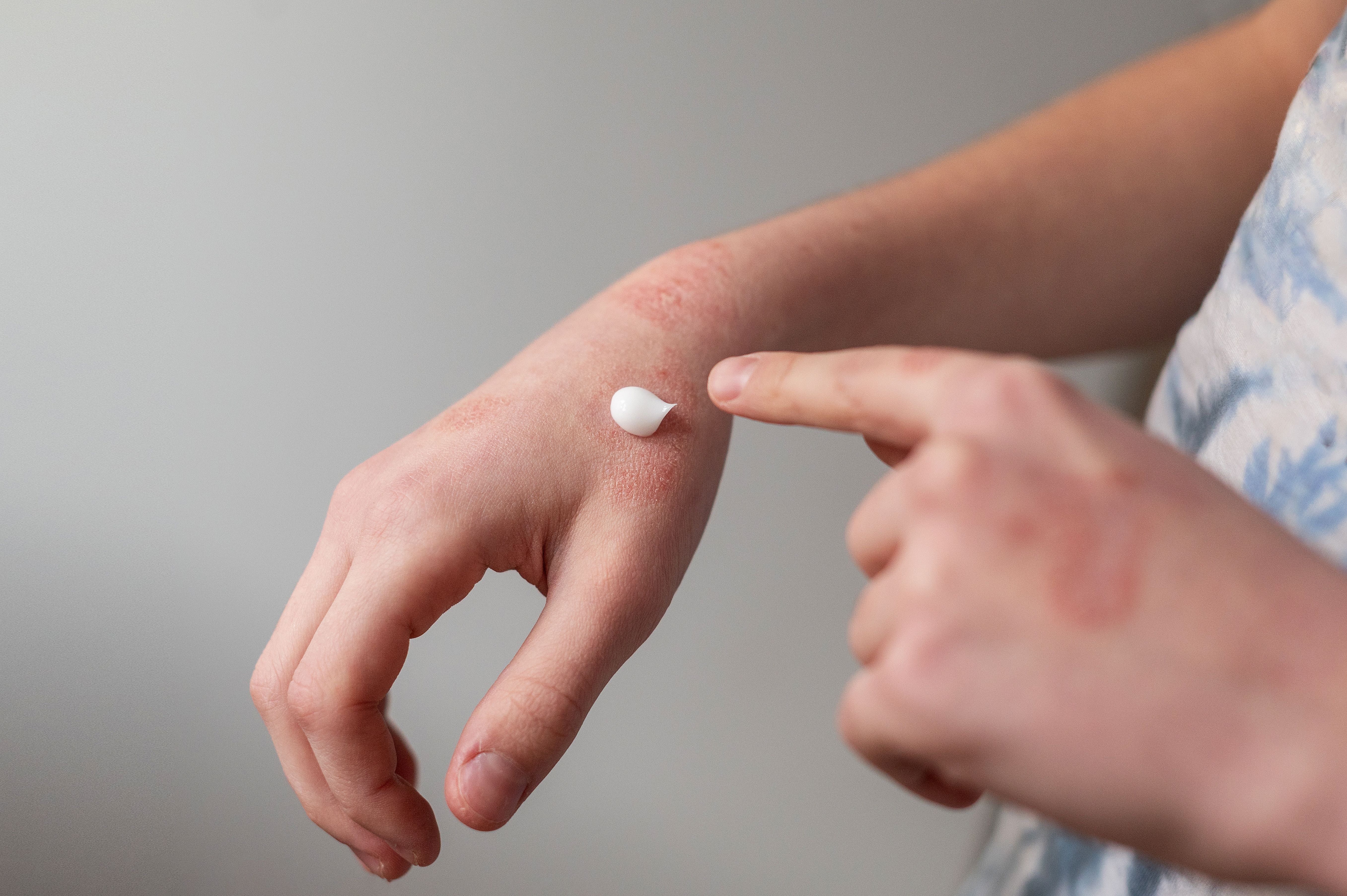 DELTA TEEN Trial Demonstrates Superiority of Delgocitinib Cream in Adolescents With Chronic Hand Eczema