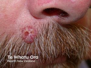 Medicus Pharma Completes Phase 2 Enrollment of D-MNA Study to Non-Invasively Treat BCC