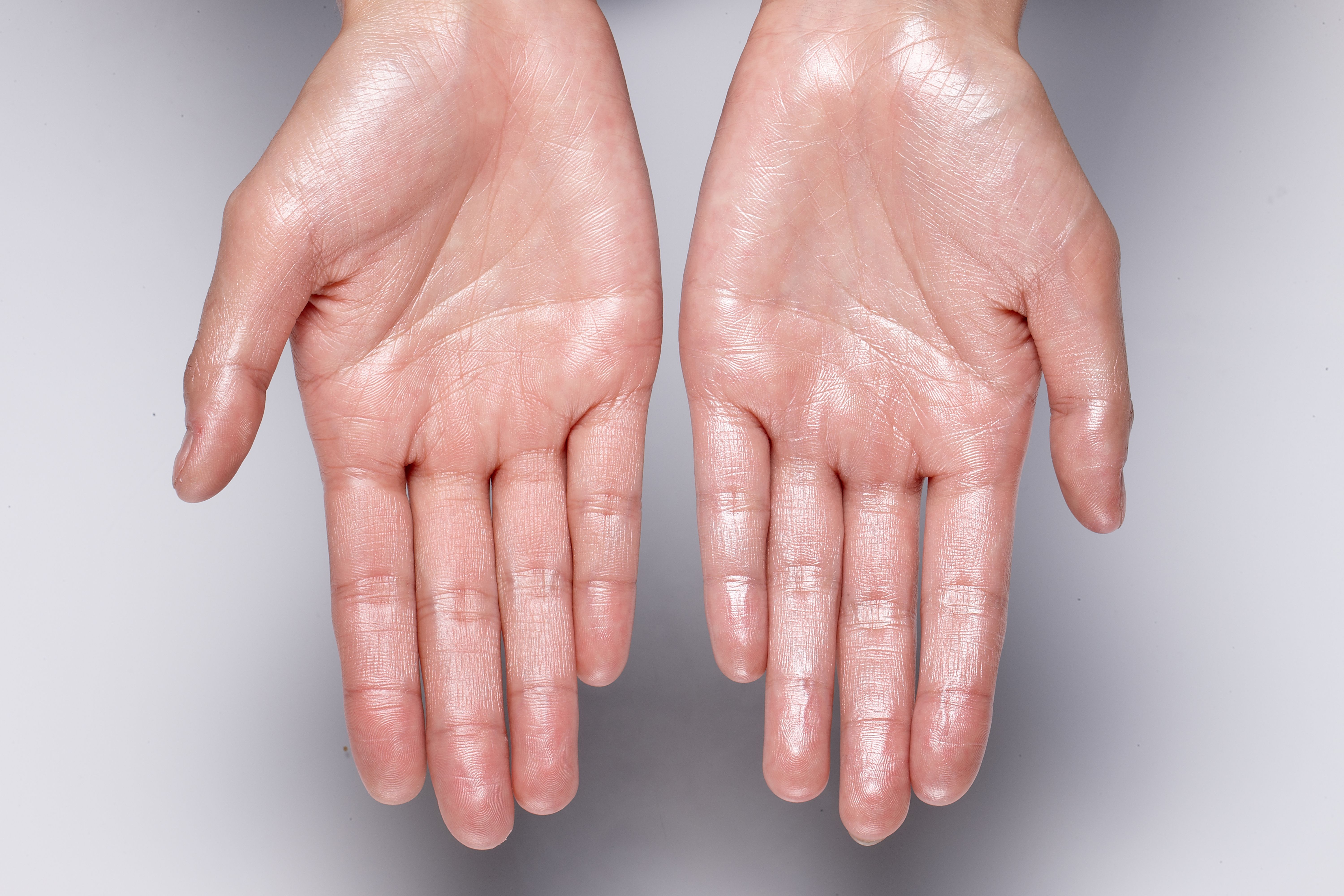 Test Your Knowledge: Hyperhidrosis Diagnosis and Treatment