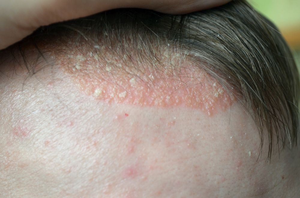 scalp psoriasis