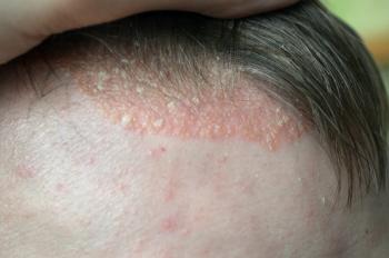 scalp psoriasis