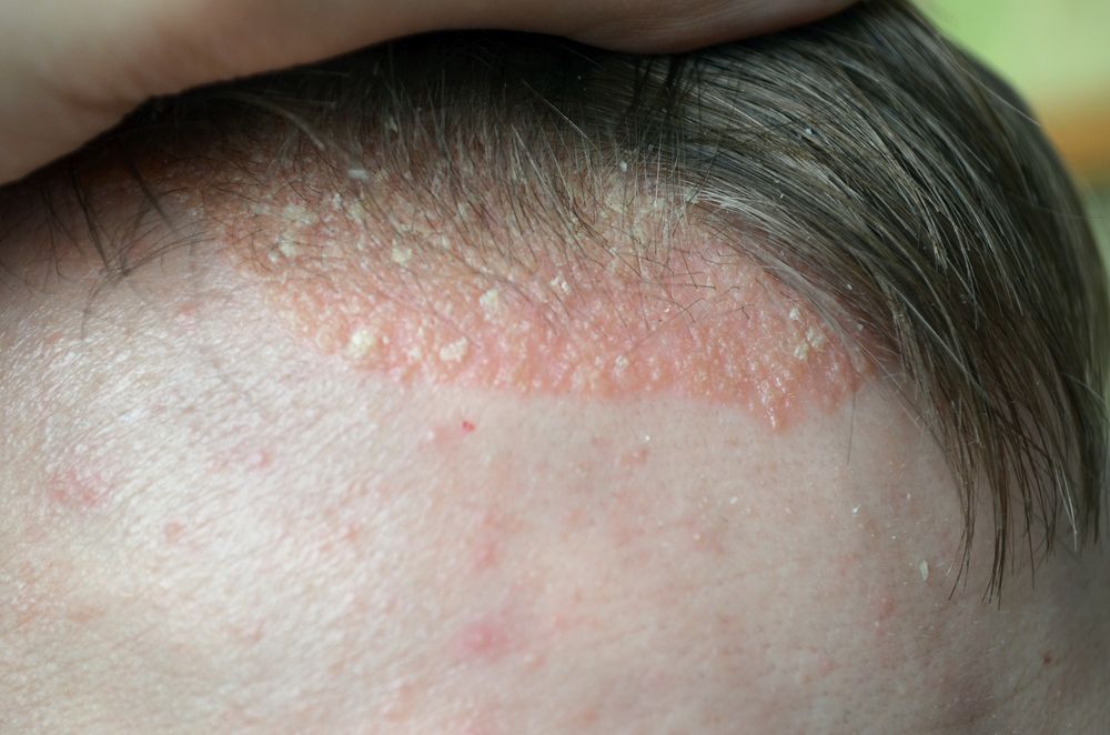 what is meant by psoriasis in marathi