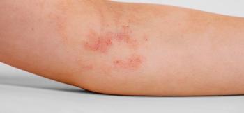 Ruxolitinib Cream’s Impact on Quality of Life for Patients With Atopic Dermatitis