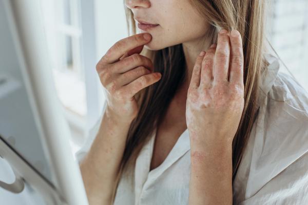 Biologic Therapy Linked to Lower 10-Year MACE Risk Across Racial Groups in Psoriasis