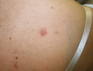 Pemphigus: Updated Review and Emerging Therapies