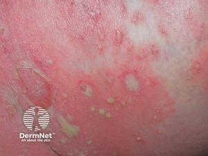 Expert Consensus Offers Age-Specific Roadmap for Diagnosing Genital Psoriasis